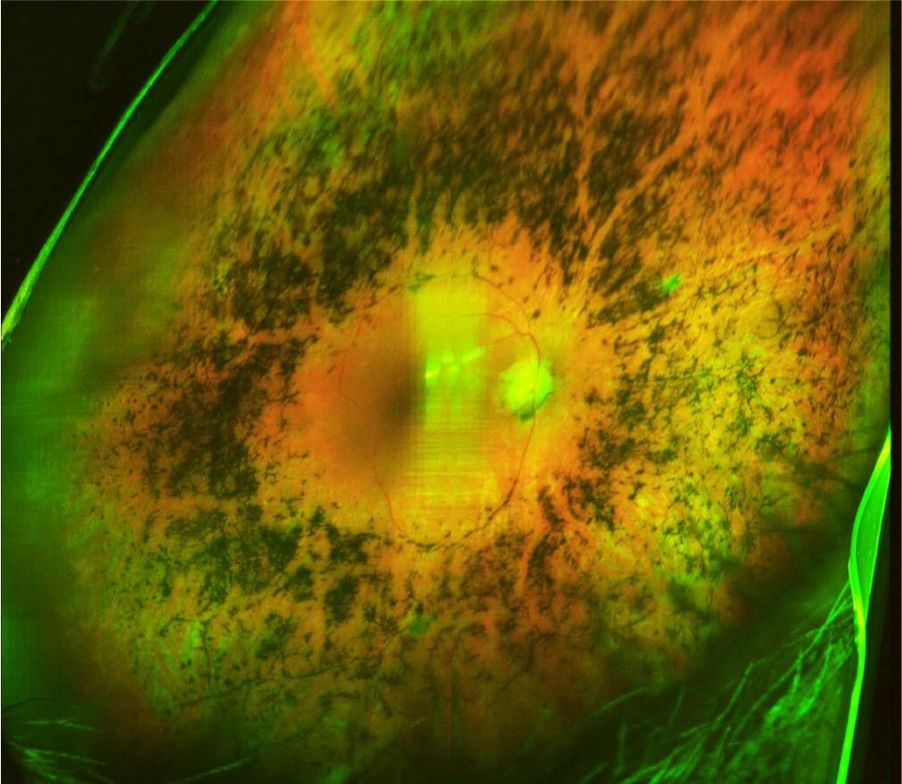 Imagen de una retina con retinosis pigmentaria